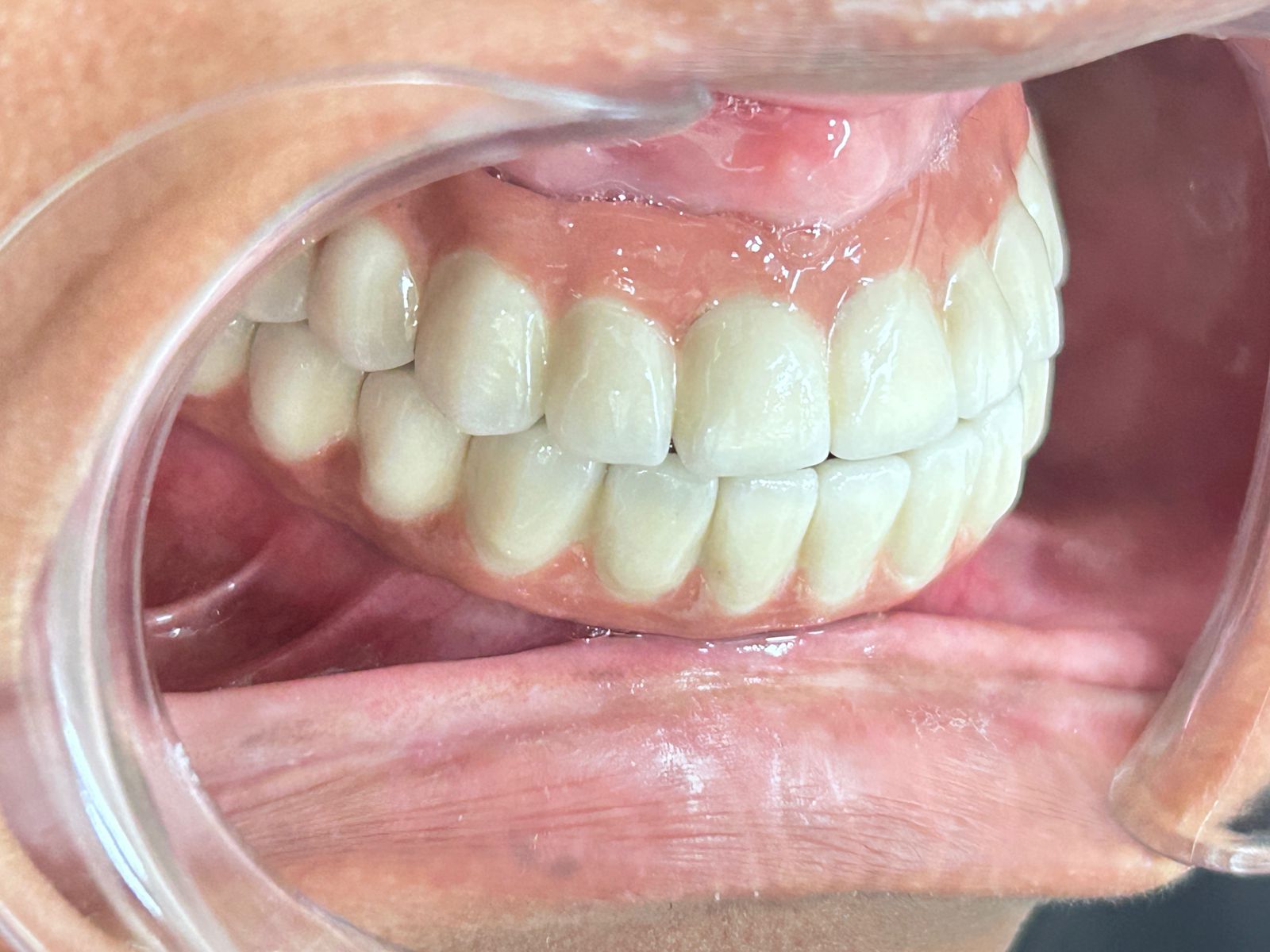 Complete Arch Denture Restoration After
