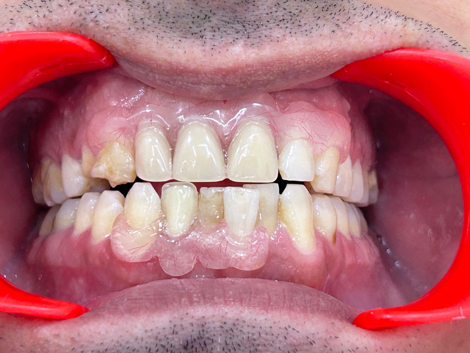 Flexible Partial Denture Restoration After