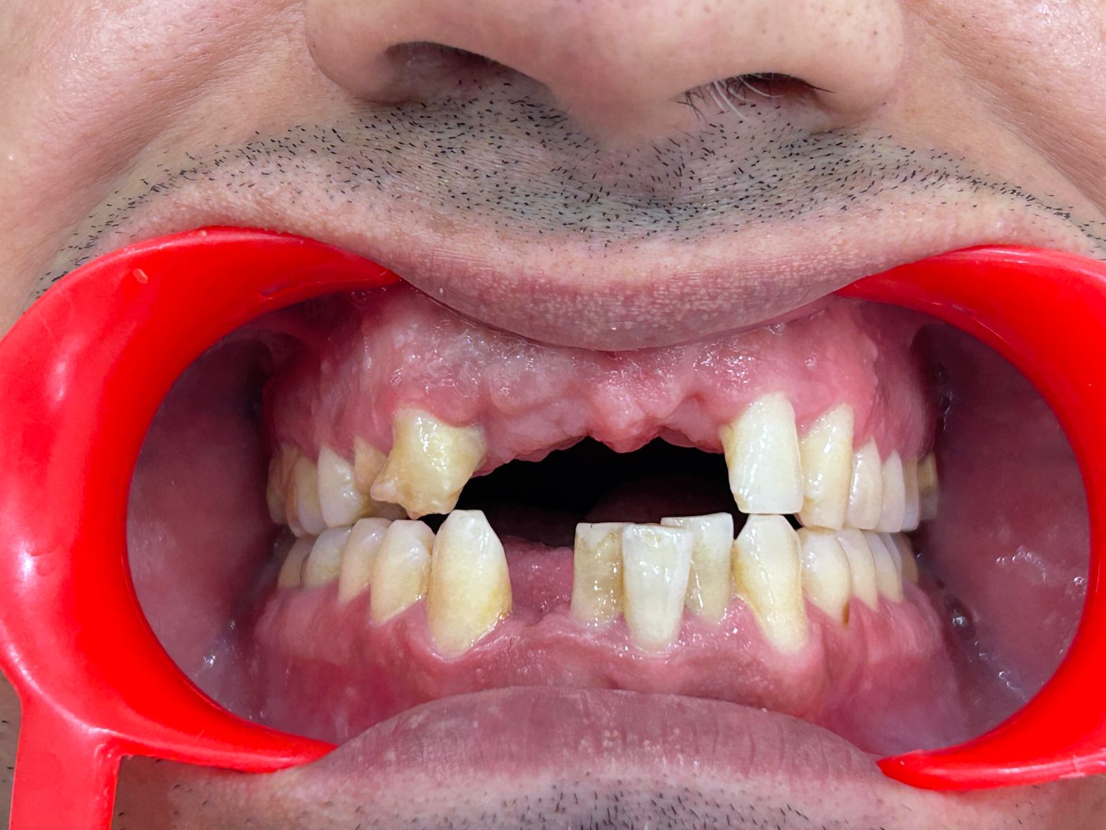 Flexible Partial Denture Restoration Before