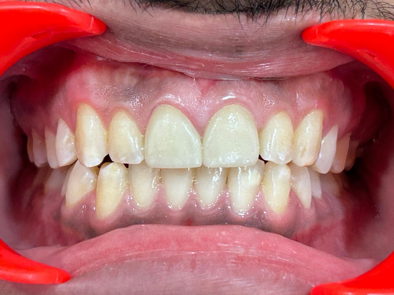Porcelain Veneer Restoration After