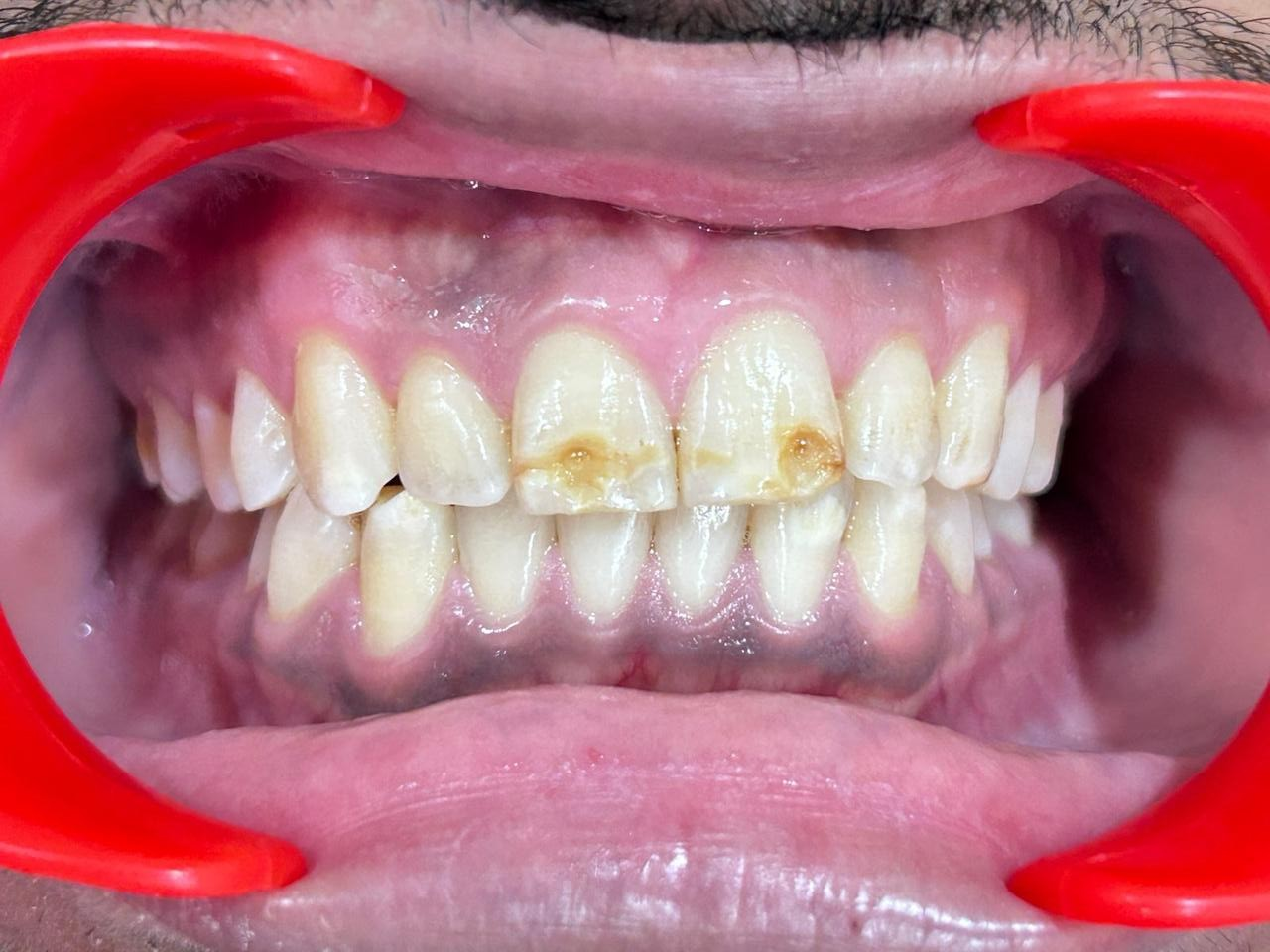 Porcelain Veneer Restoration Before